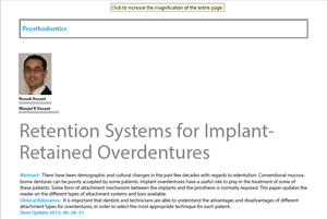 Retention Systems for Implant-retained overdentures