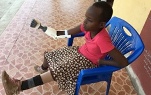 Artificial limb being fitted