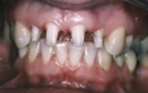 Preparations for Procera crowns