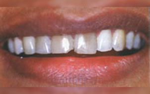 Pre-operative