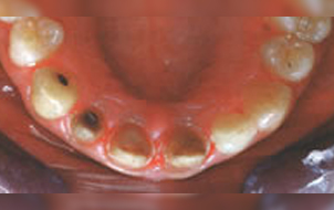 Prepared teeth
