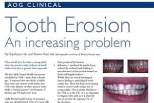 Tooth Erosion