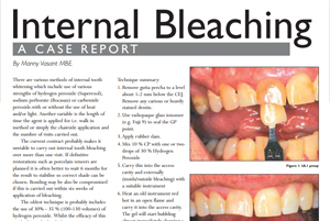 Internal Bleaching By Manny Vasant