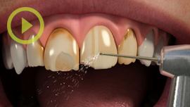 Porcelain Veneers